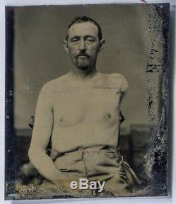 Tintype Identified Civil War Soldier Missing, Lost His Arm in the War